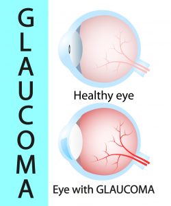 glaucoma, eye, vision, health